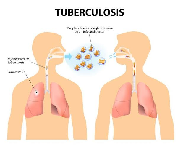 Diagram showing tuberculosis spreading through respiratory droplets from an infected person's lungs